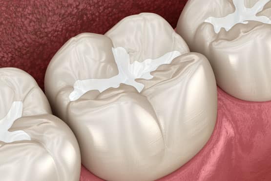 Tooth Sealants for preventing decay
