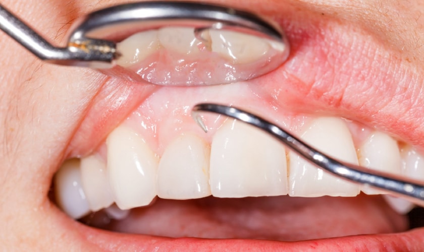 Gum Disease screening by Abilene dentist.